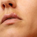 cold sore