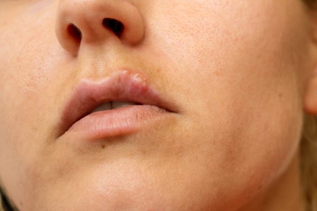 cold sore
